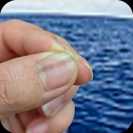 Thumb Nails Long Black Vertical Line Nails Fungus Infection Nails Vertical Lines Bump Uneven Nails H