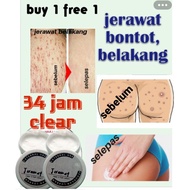 krim putih kulit,krim jerawat bontot,jerawat punggung,jerawat belakang,bontot hitam,parut punggung,m