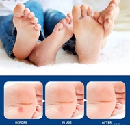 Corn pads Corn plaster Foot Care Wart Remover Pads L93C