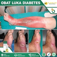 Obat Luka Diabetes Agar Cepat Kering - Obat Luka Diabetes - Obat Pengering Luka Diabetes - Obat Luka