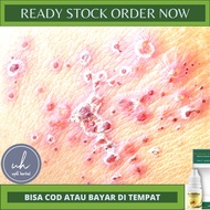 OBAT PENGHILANG BEKAS CACAR DIKULIT OBAT PENGHILANG BEKAS CACAR AIR CACAR API CACAR ULAR OBAT PENGHI