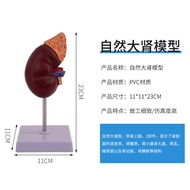 Blue butterfly | Anatomical Kidney Model with Adrenal Gland Enlarged Pathology