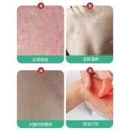 Skin Soothing Skin Health Cream Soothes Itchy Redness Mosquito Bites Bites Bites Discomfort External