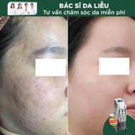 Điều trị hồng ban sau mụn, giãn mao mạch bằng IPL (F-SR)