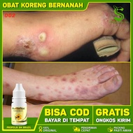 Obat Koreng Bernanah - Obat Untuk Koreng Bernanah - Obat Gatal Koreng Bernanah - Obat Koreng Bernana