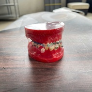 Orthodontic consultation jaw model - Consulting jaw model with braces