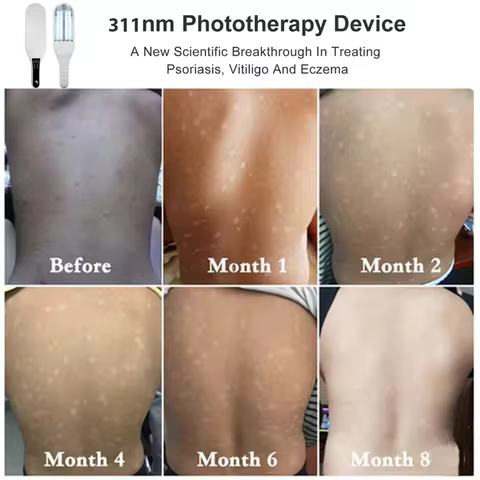 311nm Ultraviolet Phototherapy Instrument Double Lamp UVB Lamp for Vitiligo Treatment Psoriasis Lamp