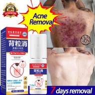 Back acne spray  Acne spot scar treatment 60ml Antibacterial Oil control Herb Fast healing back For 