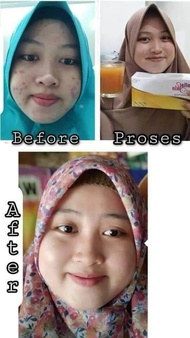 collaskin collagen NASA//penghilang bekas jerawatt// ampuh menyamarkan Stretch Mark//menyamarkan bek