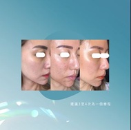 Rejuran 麗珠蘭 X 532