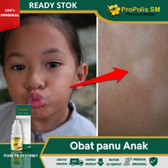 Obat Panu Anak Obat Panu Kulit Obat Panu di Wajah Anak & Dewasa Obat Hapur di Wajah Obat Hapuran Kul