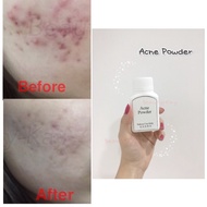 Shiyumi Acne Powder health beauty Skin care face cares control pimples remove blackhead remove scar 