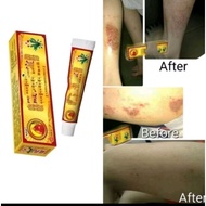Tibet Skin Ezcema Cream