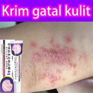 Ubat gatal kulit eczema cream psoriasis cream itchy skin cream krim gatal kulit ubat gatal herba cin