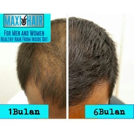 (FAST RESULT) Vitamin Pelebat/Penumbuh Rambut Gugur, Botak Set DHT Blocker Maxi Hair Biotin Premium 