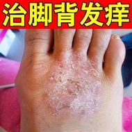 Instep Itchy Foot Skin Dry Skin External Use Cream Foot Up Red Pimples Red Dots Instep Skin Itchy Sp