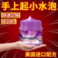 ✸✆ Sweat Herpes Cream Eczema Special Effect for Removing Small blisters on Hands Peeling Hand and Foot Tinea Root Fungal Infection Anti Itching Imported