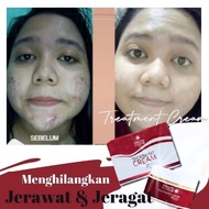 Sakura Treatment Cream 3X Booster Whitening 10G Mengurangkan Jerawat Dan Jeragat Original Hq