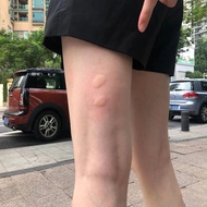 Rheumatism bumps on the legs have small red spots, thigh roo腿上起风湿疙瘩长小红点大腿根红血点腿发痒湿疹荨麻疹皮肤过敏3-31n
