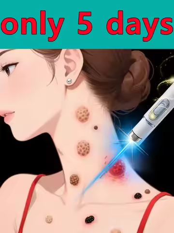 Blue light wart removal tool, more discounts on sets