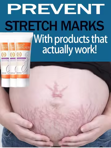 Stretch Marks Permanent Removal Cream Eliminate Body Belly Stretch Marks Swelling Marks Remove Skin 