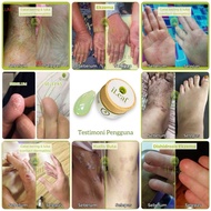 ILEAF BALM, Sapuan untuk Gatal, Ekzema, Dishidrosis Ekzema, Kudis, kulit berkerak, Ruam, dll