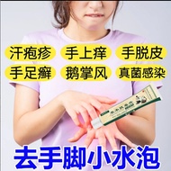 2026新款汗疱疹手上小水泡手痒脱皮干裂起水泡皮肤止痒膏皮肤瘙痒湿疹Dyshidrotic eczema: small blisters on the hands, itching, peeling,