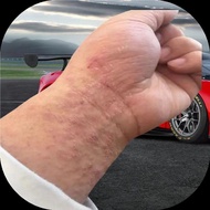 Arms Itching Itching Body Itching Itching When Hot Skin Red Spots Eczema Itching Relieve Itching Fun