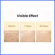 ﹊ ▨ ✪ Safeguard DETOX Acne Soap Dual Use Wash 99.9% Bacteria New Old Packaging Random Chamomile Whi