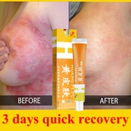 Psoriasis cream Eczema herbal cream itchy skin medicine, herbal cream, ringworm cream and itching, i