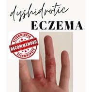 🔴 DYSHIDROTIC ECZEMA - ✴️ INSTANT EFFECTIVE ✴️