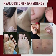 Jaysuing Warts Mole Remover Serum Pen Original Skin Tag Wart Remover Cream Original Warts Remover Ef