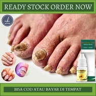 Obat Tetes Jamur Kuku Obat Penghilang Jamur Kuku Obat Jamur Kuku Kaki Dan Tangan Obat Infeksi Jamur