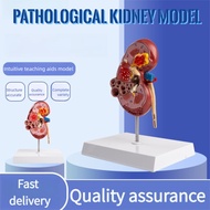【Fast Shipping】Pathological Kidney Model Kidney Model Human Internal Organ Model Natural Large Kidne
