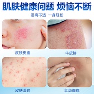 German Wolf Venom Cleansing Cream Venom Blister Blister Skin Itching Hand Foot Peeling Mosquito Bite