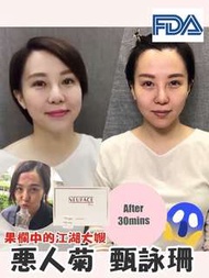 Neuface 隔空無針埋缐術