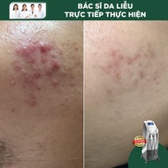 Điều Trị Mụn Bằng IPL (Cơ Bản) Thẩm mỹ không xâm lấn