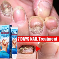 Nail Repair Cream Ubat Kuku Rosak Antibacterial Nail Fungus Treatment Ubat Herbal Membaiki Kuku Rosa