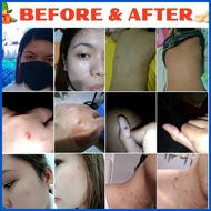 ✩ ❀ ⚛ Warts remover original Mole remover Skin tag remover Removal freckle and melanin spots