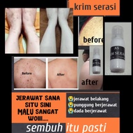 krim serasi /jerawat belakang/jerawat di punggung/rawat parut