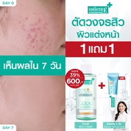 [เซ็ตสุดคุ้ม] Smooth E Cleansing water 400 ml. & Ance Hydrogel เซ็ทสิวหาย 2 สเต็ป: ดีท็อก 5 เชื้อสิว