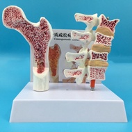 2 parts PVC Human Anatomical Model Osteoporosis Femur Leg Bone Spinal Section Specimen Diseased Lumb