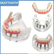 Implant Dental Model With Implant Overdenture Inferior Lower Tooth Implant Removable Model For