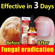 Ingrown Toenail Treatment Fungus Treatment Medicine Toenail Corrector Paronychia Pain Relief Paronyc