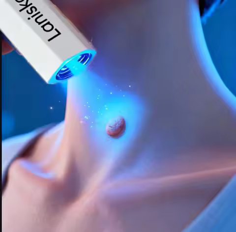 4Deep Sterilization Laser Pen Treatment for Flat Warts Condyloma Acuminatum and Various Warts Painle