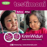 [RECOMMENDED]WIDURI Psoriasis Eczema Cream Antifungal Itchy Ubat Gatal Kurap Krim Ezcema Ekzema