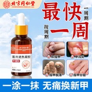 北京同仁堂 灰指甲护理液灰甲净发黄变空增厚药 足部护理去灰甲抑菌液脚趾甲萎缩真菌感染指甲20ml/盒 2盒【中度灰指甲专用】